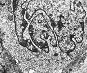 F, 37y. | mycosis fungoides … cerebriform nucleus of Sézary cell